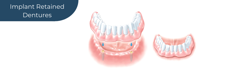 Diagram showing Implant Retained Dentures