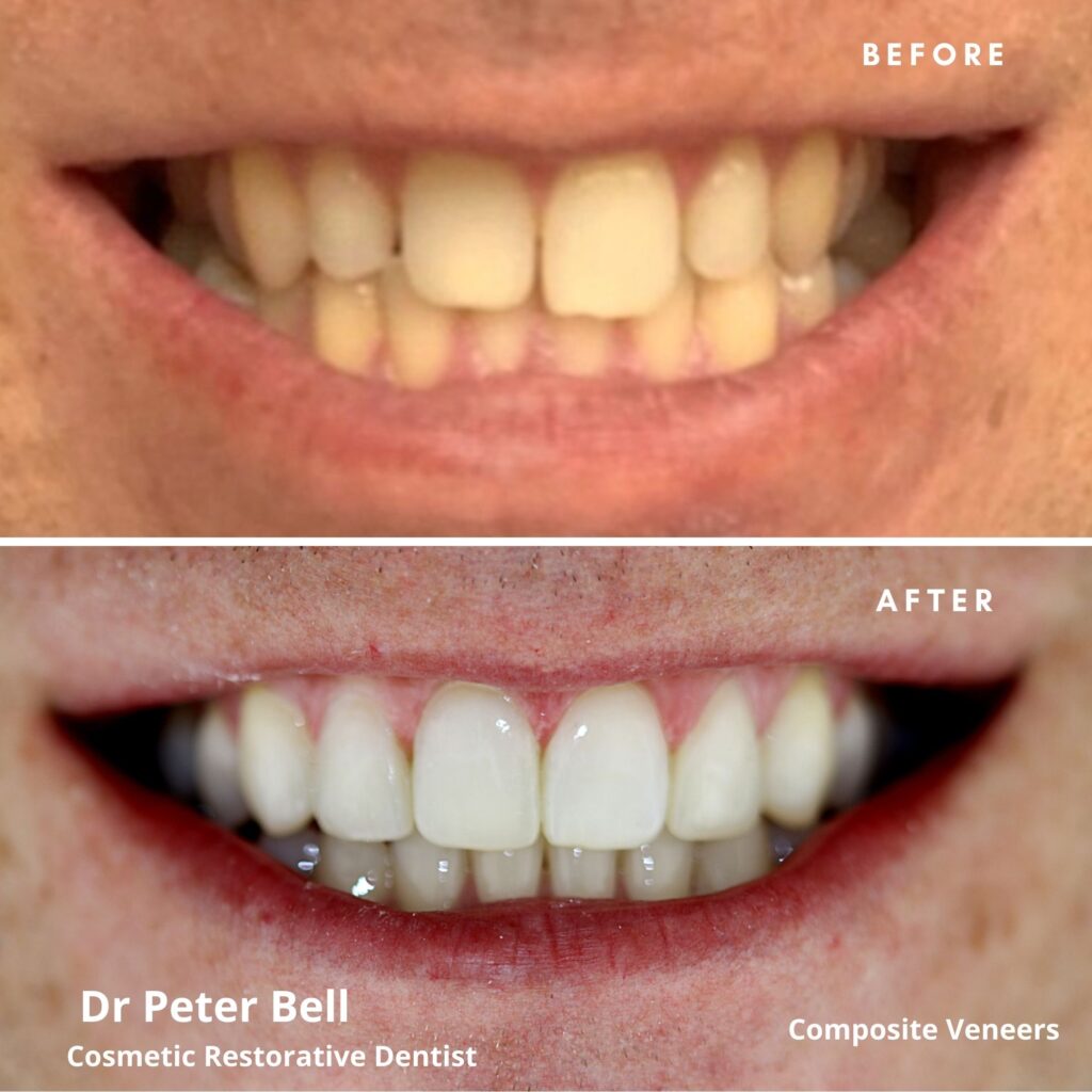 Before and after results of teeth whitening by Dr Peter Bell at The Town House Dental Practice in Tunbridge Wells